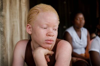 Albinisme en Afrique : comprendre les discriminations et soutenir les solutions inclusives